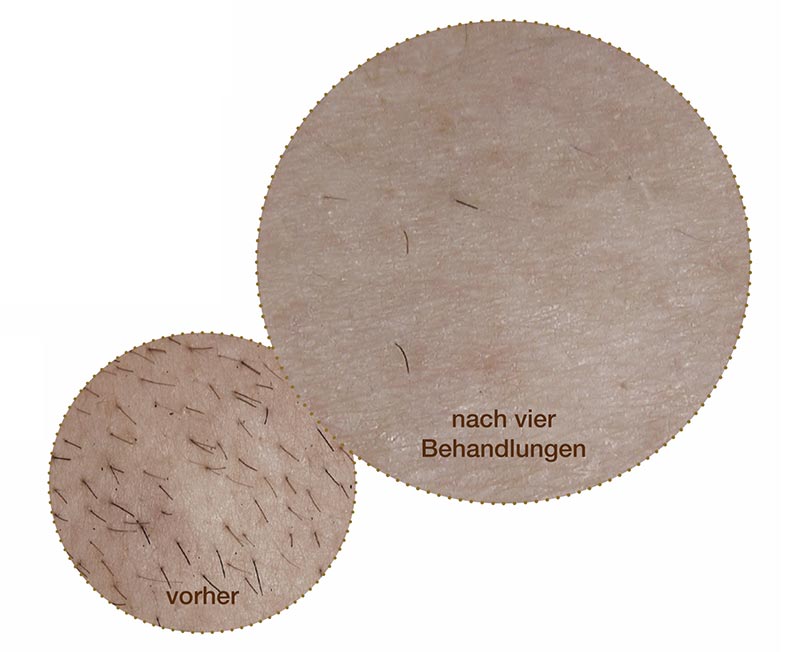 Dauerhafte Haarentfernung