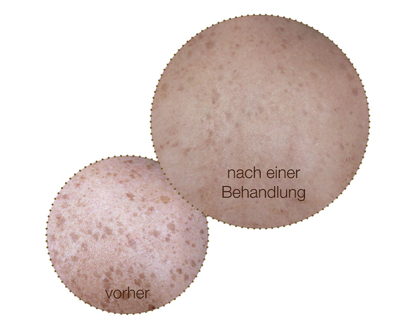 ipl anti-aging