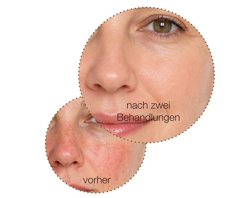 ipl anti-aging